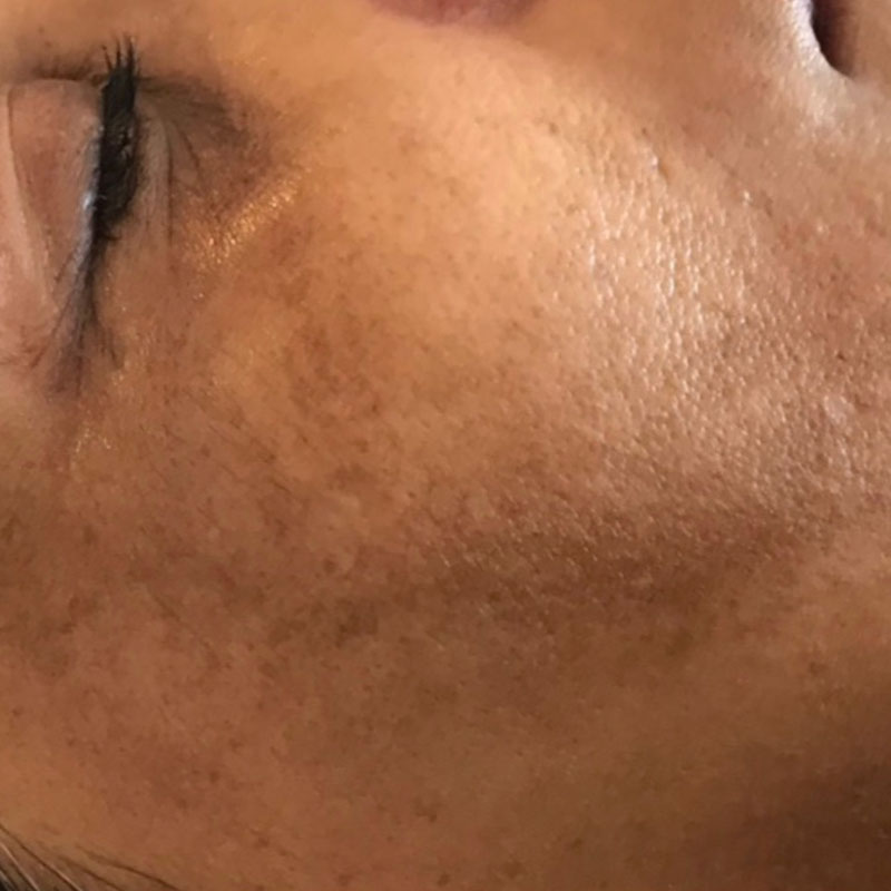 before microneedling treatment in Teddington