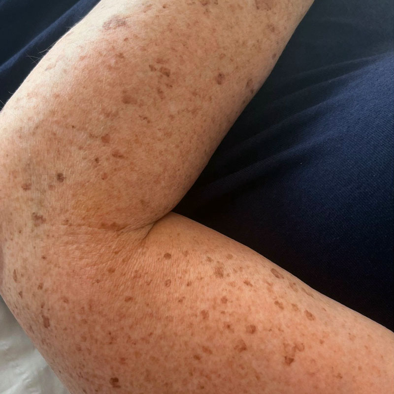 Results after IPL treatment for freckle and pigmentation reduction, Teddington
