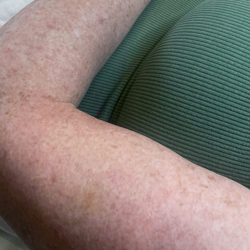 Results before IPL treatment for freckle and pigmentation reduction, Teddington