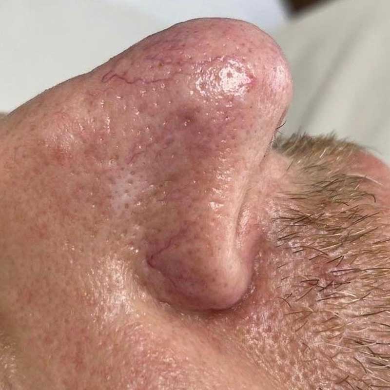 Skin appears clearer after IPL treatment with reduced redness and veins