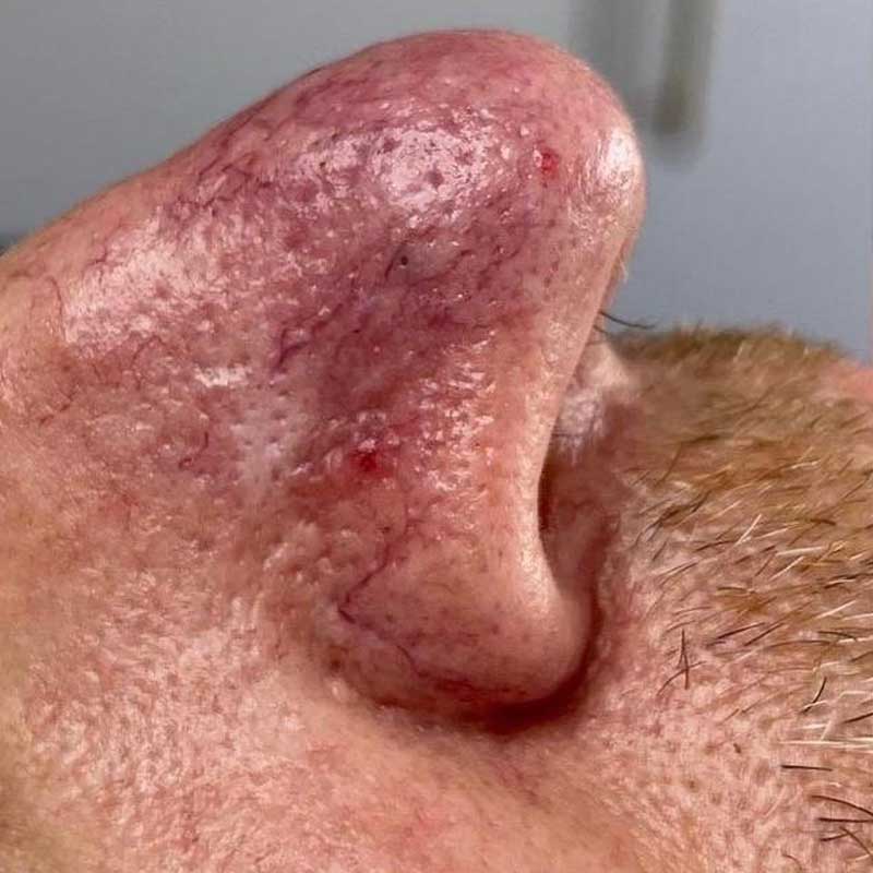 Skin with visible redness and thread veins before IPL treatment
