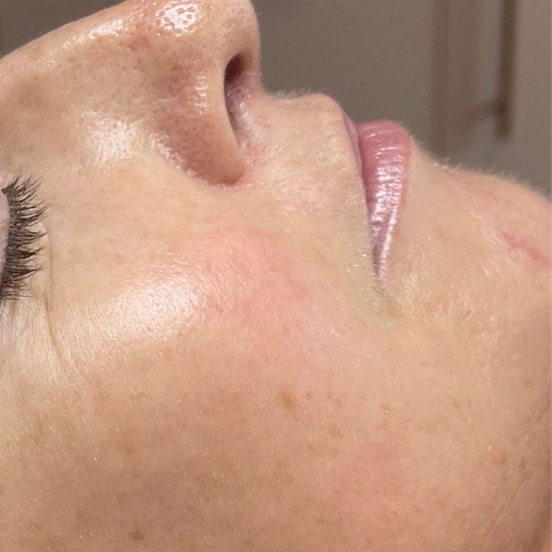 Skin appears clearer after IPL treatment with reduced redness