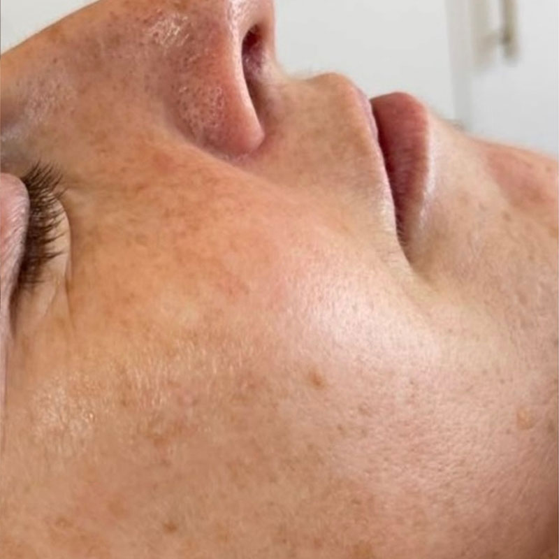 Skin before IPL treatment