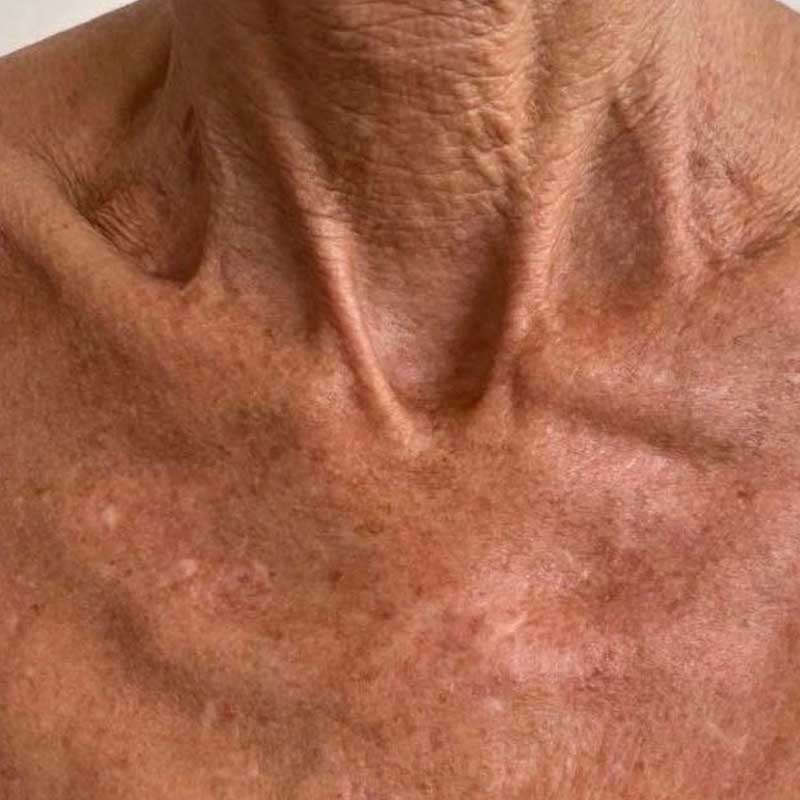 Results after radiofrequency microneedling treatment Teddington
