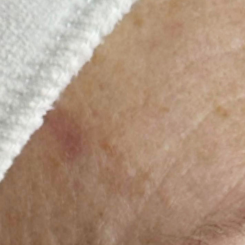 solar keratosis teddington - after treatment